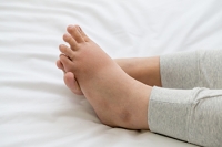 Swollen Feet and Foods to Eat