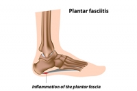 Common Causes of Plantar Fasciitis
