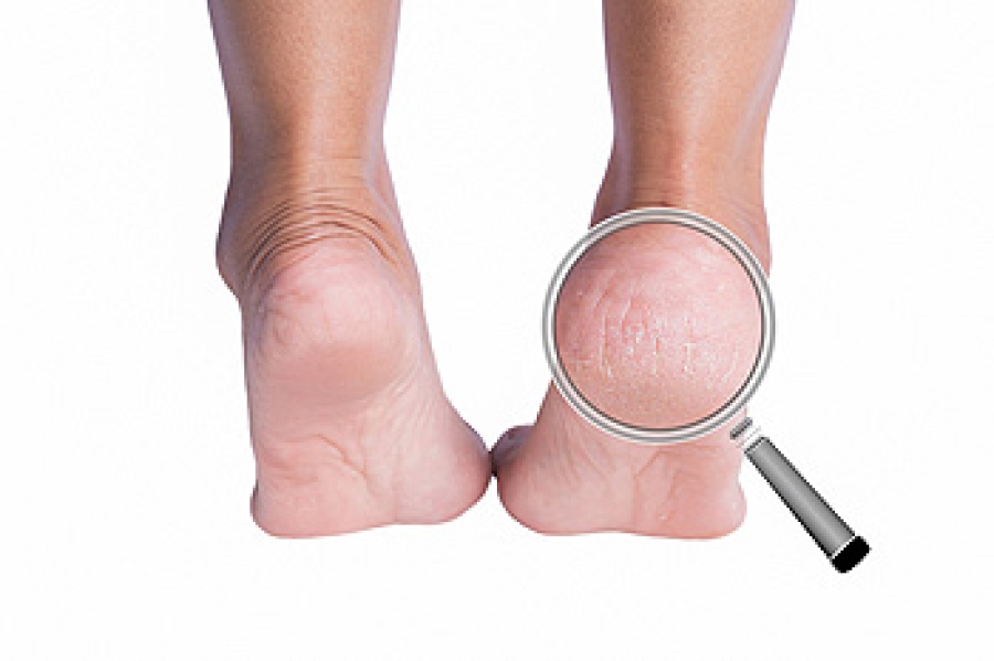 Keratolytic for cracked heels sales