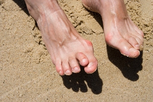 Can Hammertoe be Corrected?