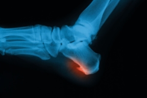 Foot Pain Location From Cuboid Syndrome