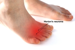 Dealing With Morton’s Neuroma