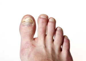 Fungi clearance toe nails